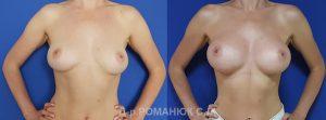 Увеличение груди в Одессе. Фото 1. Увеличение груди (молочных желез) двухгелевыми микрополиуретановыми имплантатами. Субмаммарный доступ, установка под фасцию.