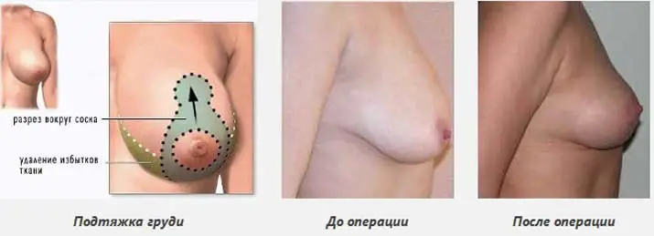 Подтяжка груди в Одессе