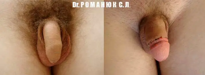 Обрезание крайней плоти в Одессе