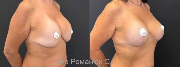 Фото 2. Контрактура имплантов, птоз молочных желез - в Одессе