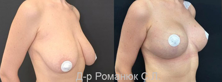 Фото 2. Уменьшение груди с имплантами - Украина - Романюк